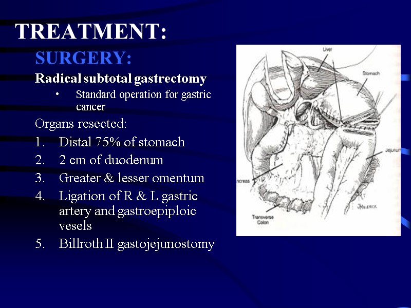 TREATMENT: SURGERY: Radical subtotal gastrectomy Standard operation for gastric cancer Organs resected: Distal 75%